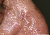 basal cell carcinoma