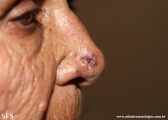 basal cell carcinoma