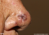 basal cell carcinoma