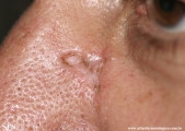 basal cell carcinoma