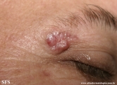 basal cell carcinoma