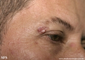 basal cell carcinoma