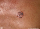 basal cell carcinoma
