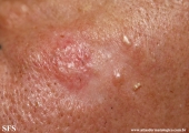 basal cell carcinoma