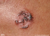basal cell carcinoma