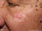 basal cell carcinoma