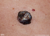 basal cell carcinoma