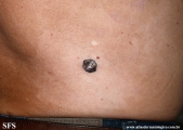 basal cell carcinoma