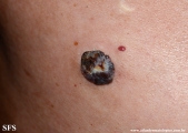 basal cell carcinoma