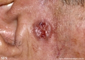 basal cell carcinoma