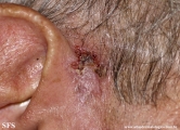 basal cell carcinoma