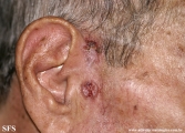 basal cell carcinoma