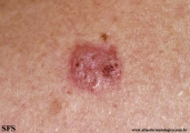 basal cell carcinoma