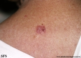 basal cell carcinoma