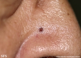 basal cell carcinoma