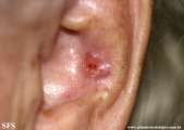 basal cell carcinoma