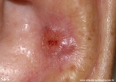 basal cell carcinoma