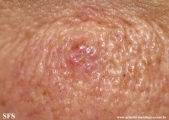 basal cell carcinoma