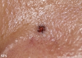 basal cell carcinoma