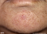basal cell carcinoma