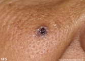 basal cell carcinoma