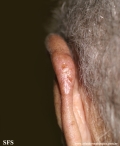basal cell carcinoma