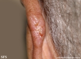 basal cell carcinoma