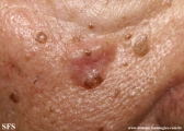 basal cell carcinoma