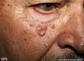 basal cell carcinoma