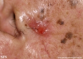 basal cell carcinoma