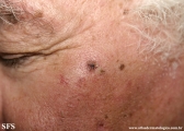 basal cell carcinoma