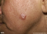 basal cell carcinoma