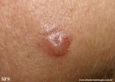 basal cell carcinoma