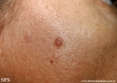 basal cell carcinoma