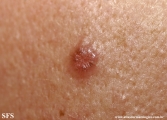 basal cell carcinoma