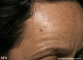 basal cell carcinoma
