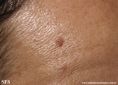 basal cell carcinoma
