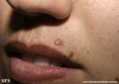 basal cell carcinoma