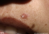 basal cell carcinoma