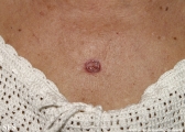 basal cell carcinoma