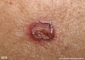 basal cell carcinoma