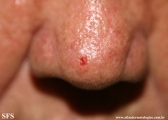 basal cell carcinoma
