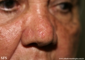 basal cell carcinoma