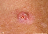 basal cell carcinoma