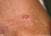 basal cell carcinoma