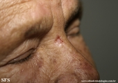 basal cell carcinoma