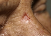 basal cell carcinoma