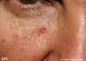 basal cell carcinoma