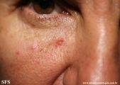 basal cell carcinoma