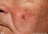basal cell carcinoma